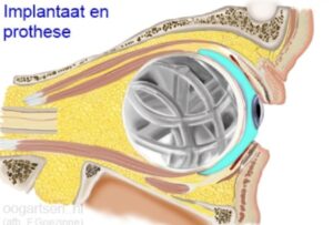 Implantaat en protese