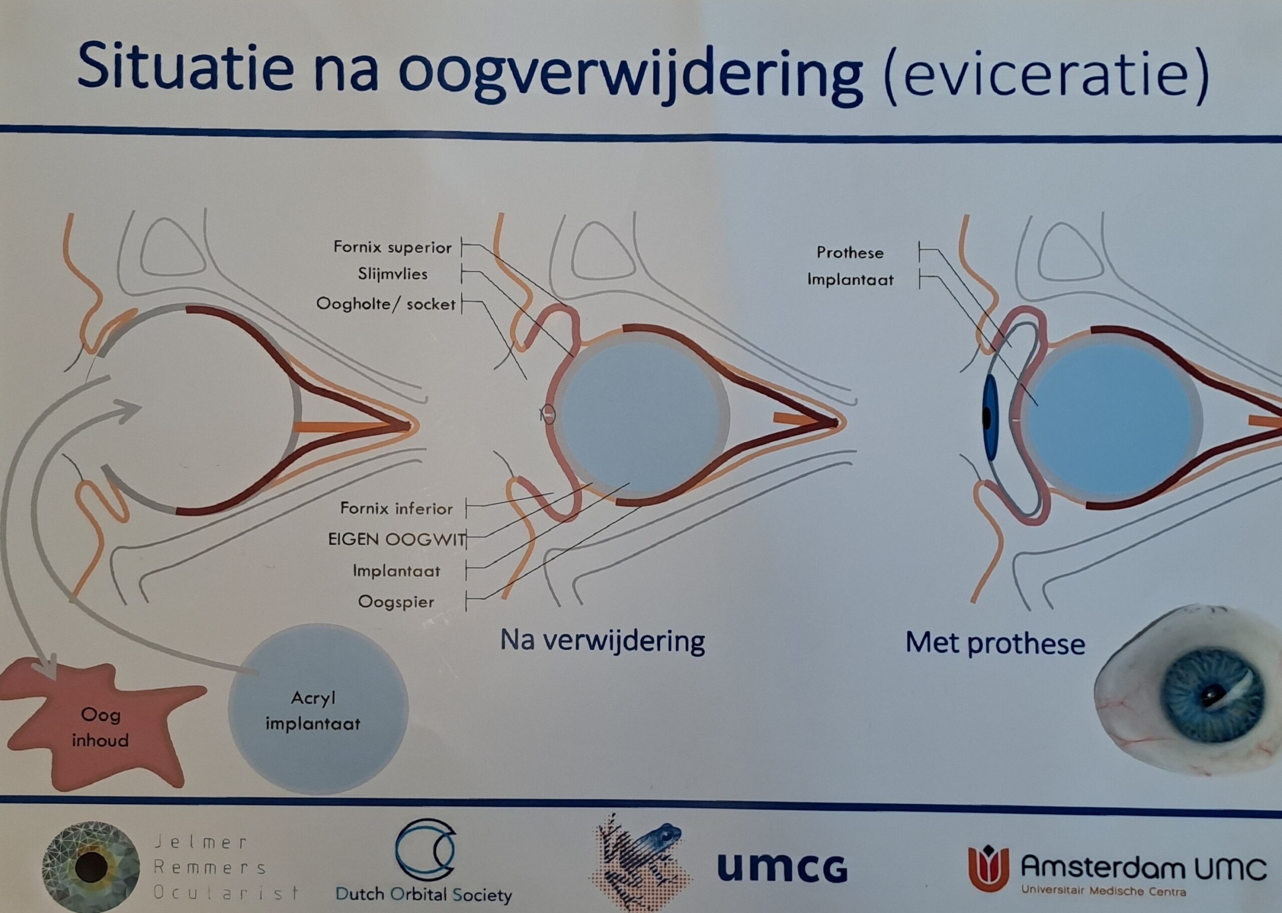 Eviceratie; Situatie na oogverwijdering